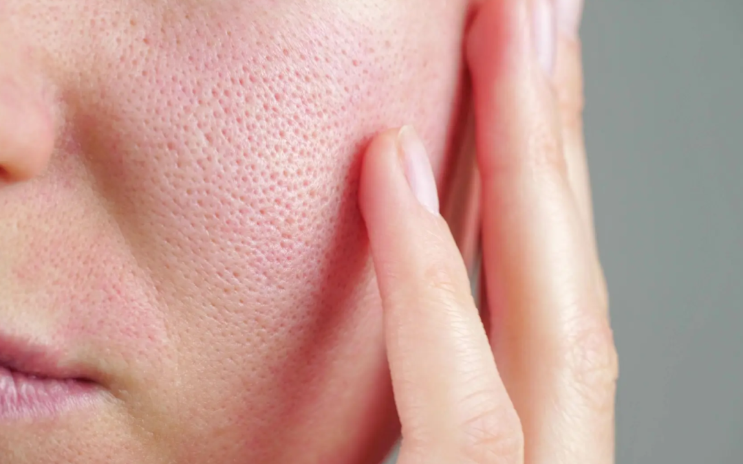 Why Does Our Skin Develop Enlarged Pores?