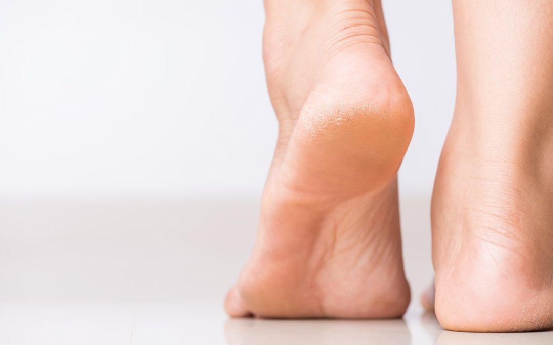 Why Is the Skin on Our Feet More Prone to Dryness Than Other Parts of the Body?