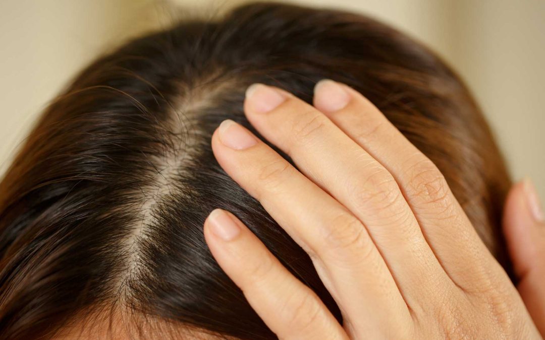 Dandruff: A Common but Manageable Condition