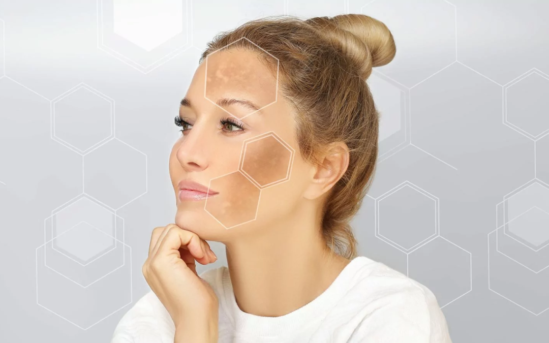 All About Skin Spots and Discoloration
