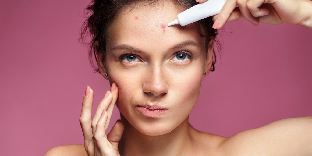 Does toothpaste really treat pimples?