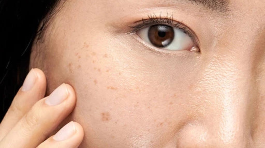 How to Reduce Brown Spots on the Face?